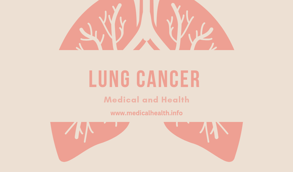 Lung Cancer (شێرپەنجەی سیەکان)