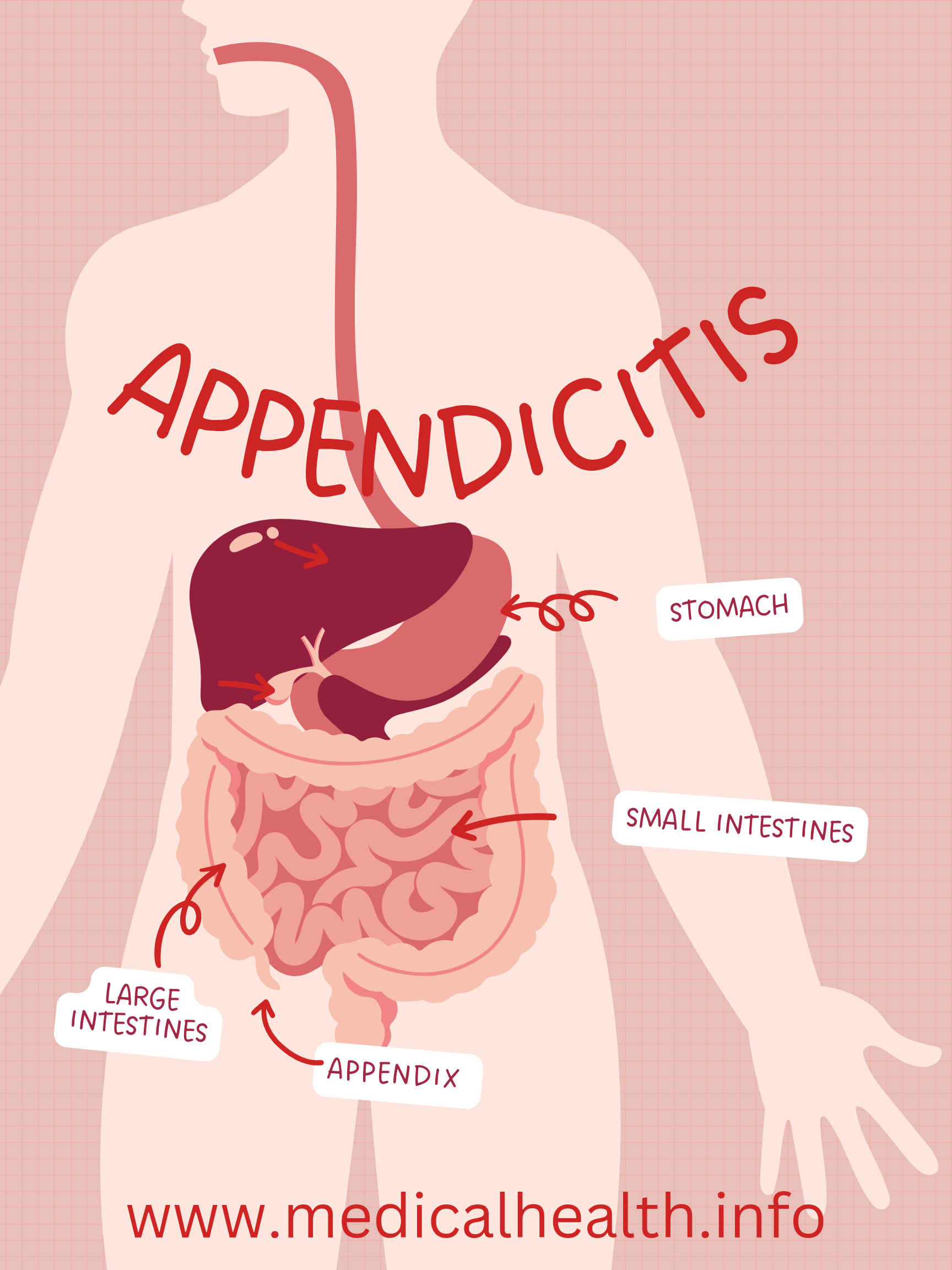 Appendicitis (ڕیخۆڵە کوێرە)